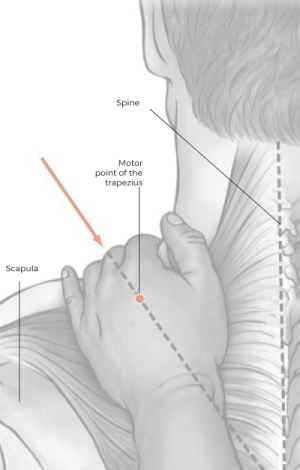 sketch showing the shoulder well and motor point of the trapezius.
