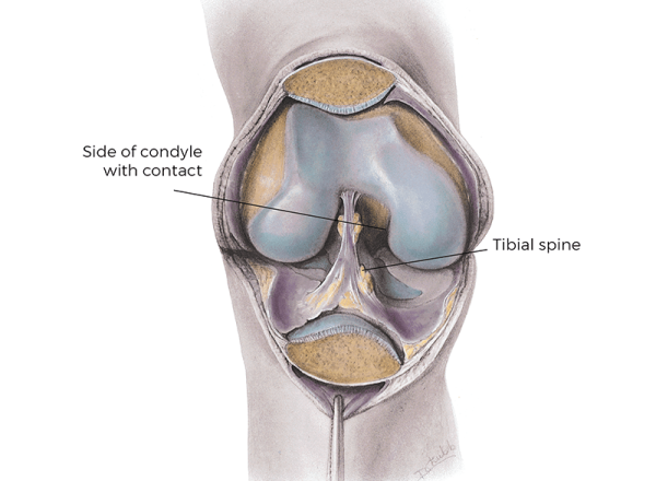 Interior anatomical view of Contact points in the knee that can lead to OCD.