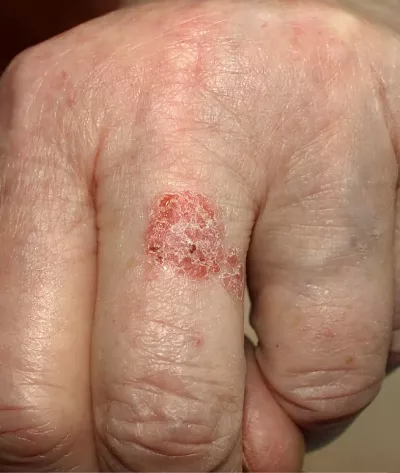 Bowen disease on a finger.