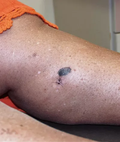 Superficial spreading melanoma.