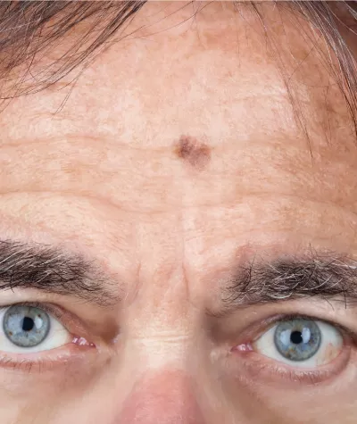 Lentigo melanoma in the middle of a person's forehead.