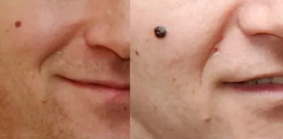 Two pictures of the same face depicting a change that arose from a nodular melanoma mole over 14 months.mole