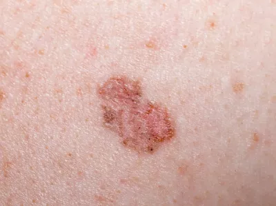 Pigmented BCC on a light-skinned person.