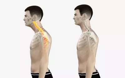 Forward-head posture examples