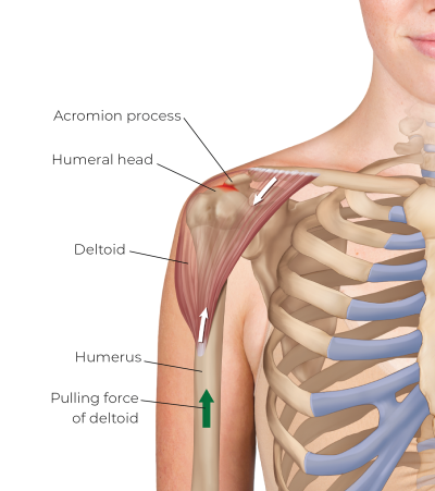 Illustration of an isolated contraction of the deltoid pulling the head of the humerus up into the acromion process.