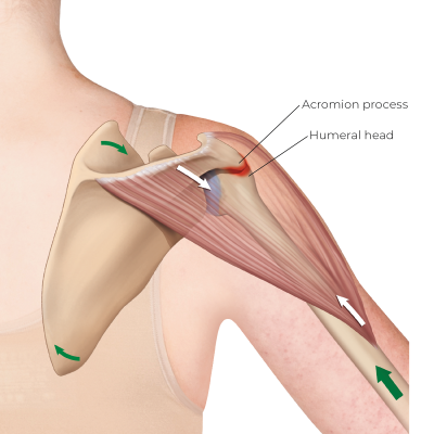 Posterior view of the right shoulder, demonstrating the deltoid's contraction force moving both the humerus and the scapula.