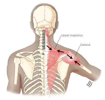 Illustration showing the upper trapezius and deltoid contracting simultaneously.