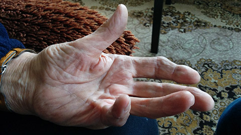 Elderly hand twisted and contorted by Dupuytrenâ€™s contracture.