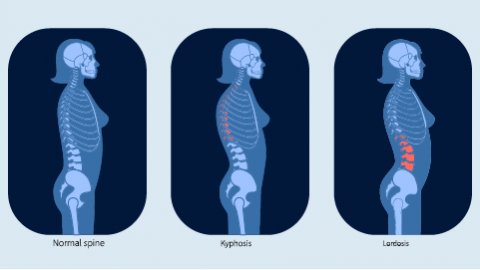 An animated image of a normal spine, Kyphosis, and Lardosis.
