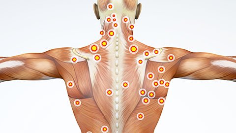 Anatomical image of muscles on a back showing multiple trigger points